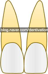  가운데 앞니 : 상악, 하악 중절치, central incisor - 치아형태 시리즈