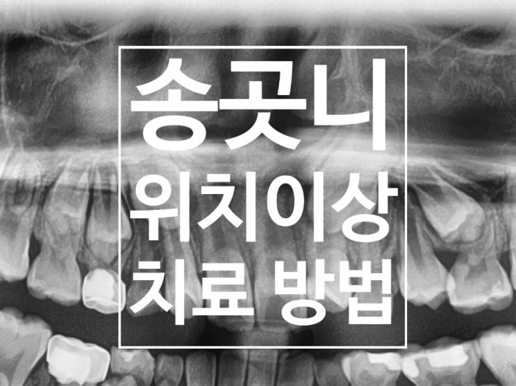 송곳니 위치 이상 또는 매복된 경우 치료 과정 및 방법(프로토콜)