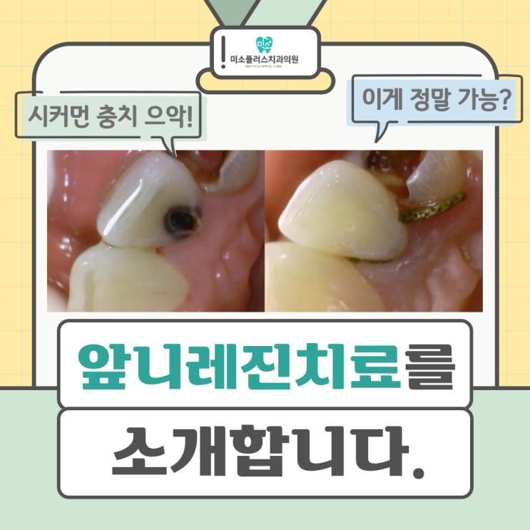  서정리역치과 평택고덕치과/앞니 레진치료1