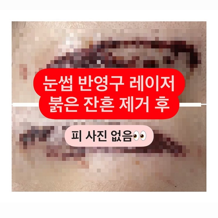 대구 눈썹 반영구 문신 제거(붉은 잔흔) 레이저 2차 후 3개월 경과 후기