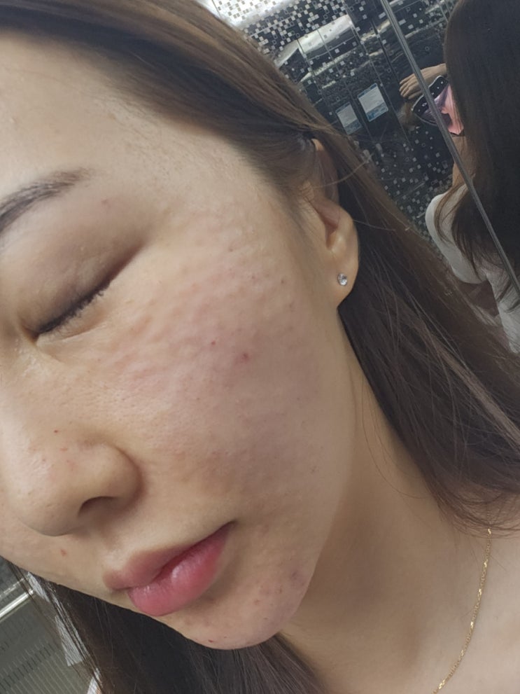  대구 서울바른피부과 리쥬란HB 통증, 엠보 등 리얼 후기