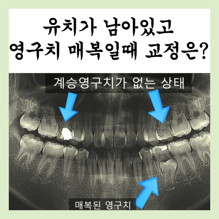  영구치가 안올라와요, 유치가 남아있을때 교정은?