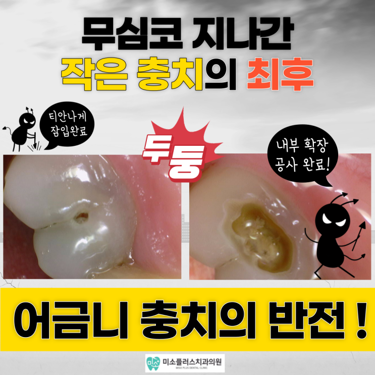  서정리역 치과 평택고덕치과/바깥쪽 레진치료