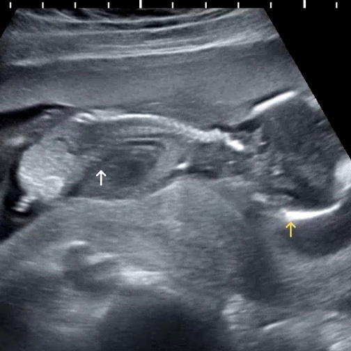 임신 16주 2차 기형아 검사, 엎드려 있는 아기 초음파 성별 확인!