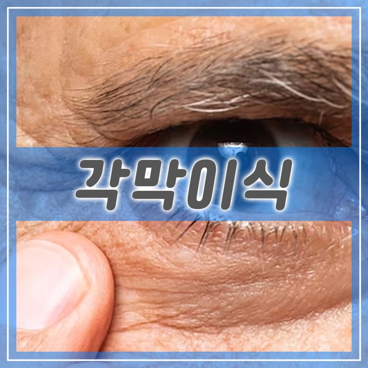  각막이식 수술의 필요성과 부작용, 주의사항