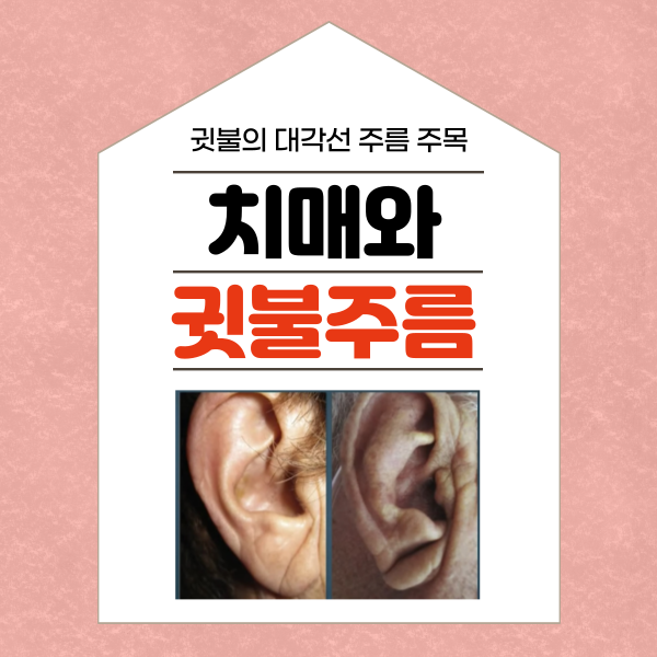 귓볼주름,대각선 깊은 주름은 치매와 뇌졸중의 전조증상?