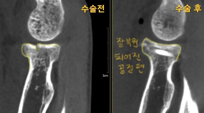 넘어지며 발생한 요골 골두의 골절 수술을 해야 하나요? 해야 한다면 어떻게 언제 재활을 하나요? 언제 복귀할 수 있을까요 ...