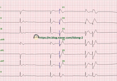  베타차단제(Beta blocker) 약물중독(DI) 치료 글루카겐 하이포키트