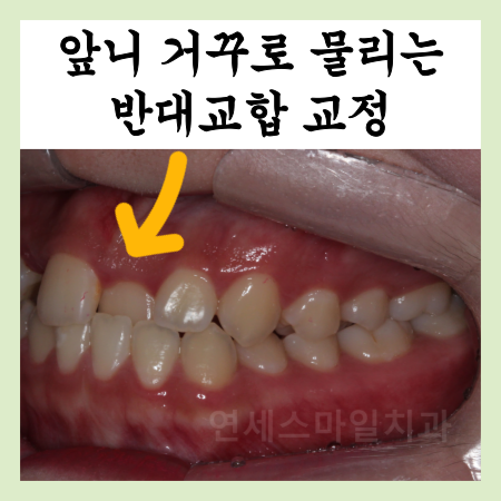  앞니가 거꾸로 물리는 반대교합 교정으로 개선
