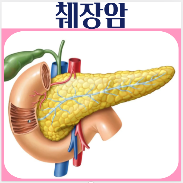  췌장암 원인 초기증상 체중변화 황달 소화장애