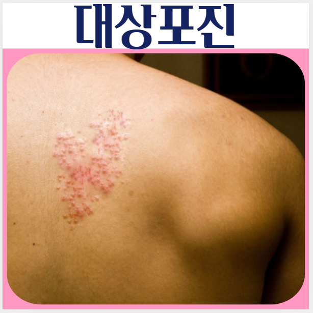  대상포진 원인 초기증상 치료 전염 예방접종
