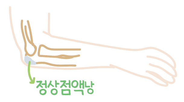 팔꿈치에 물혹이 생겼어요, 재활의학과 전문의가 알려주는 주두점액낭염의 치료