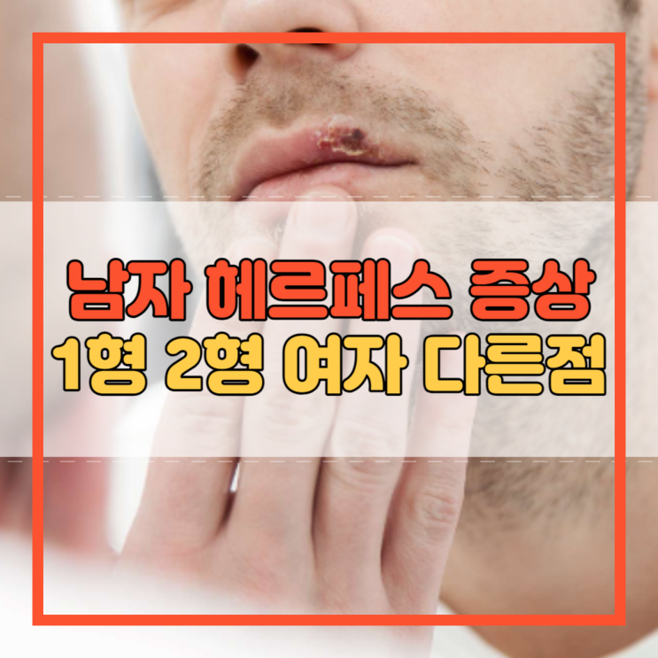  남자 헤르페스 증상 1형 2형 여자 다른점은?