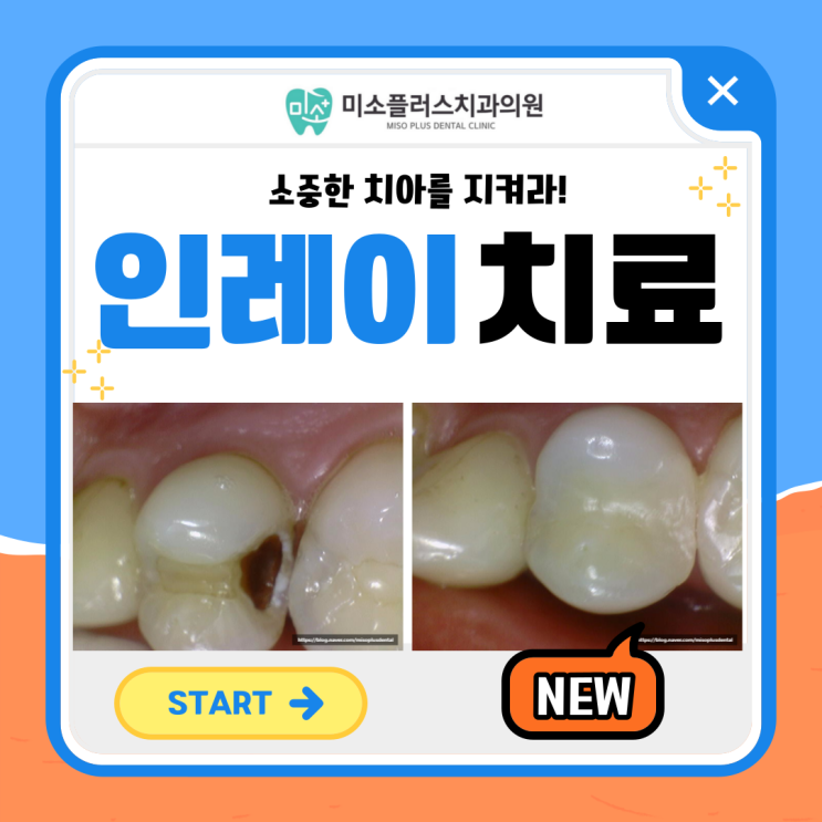  평택고덕치과/인레이치료1