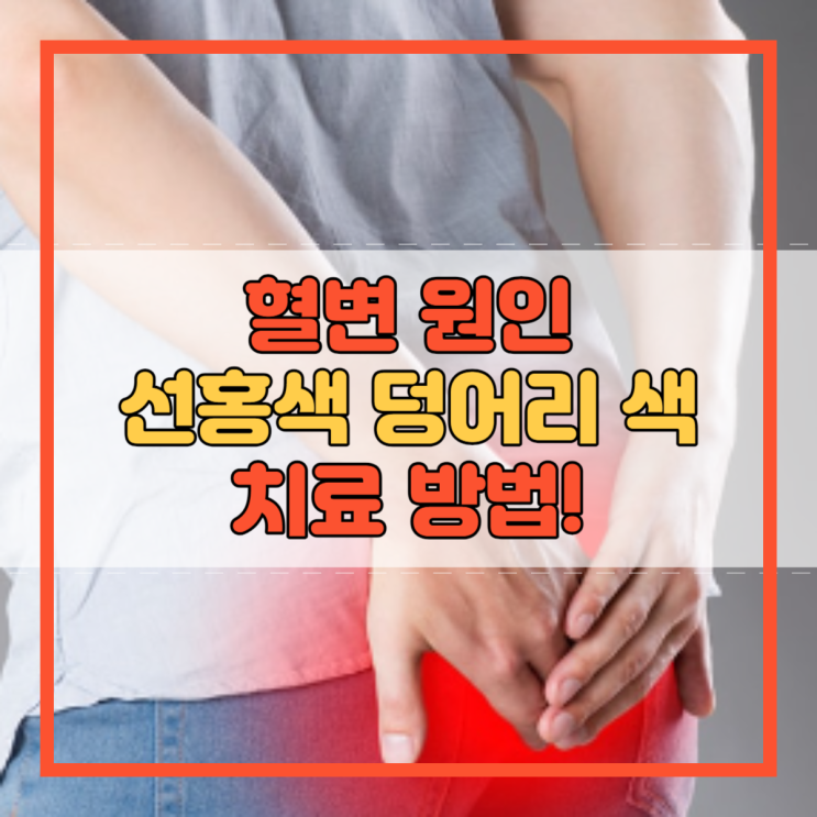  혈변 원인 선홍색 덩어리 색 치료 방법!