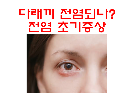 [성내동 근처 천호역 그랜드성모안과] 눈 다래끼 전염 되나요? (다래끼 초기증상, 다래끼 빨리 낫는법 5가지)