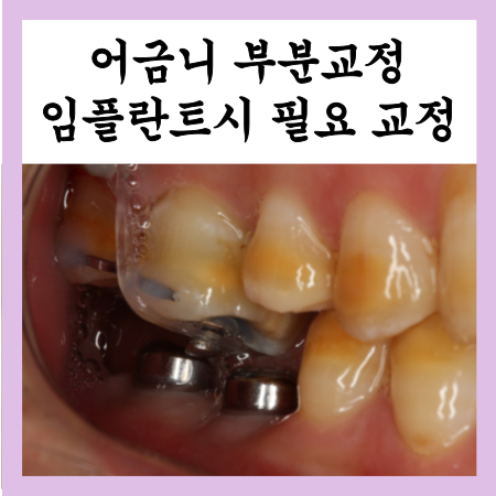  어금니 부분교정, 임플란트를 하는데 교정이 필요한 경우