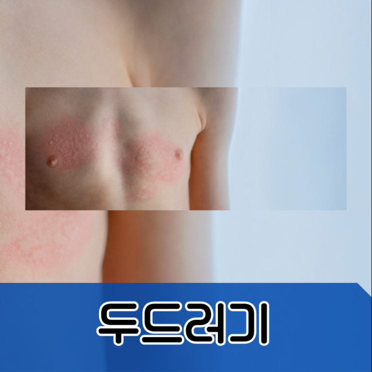  두드러기 밴드 벨트 고무줄 자국 피부묘기증 피부 기묘증