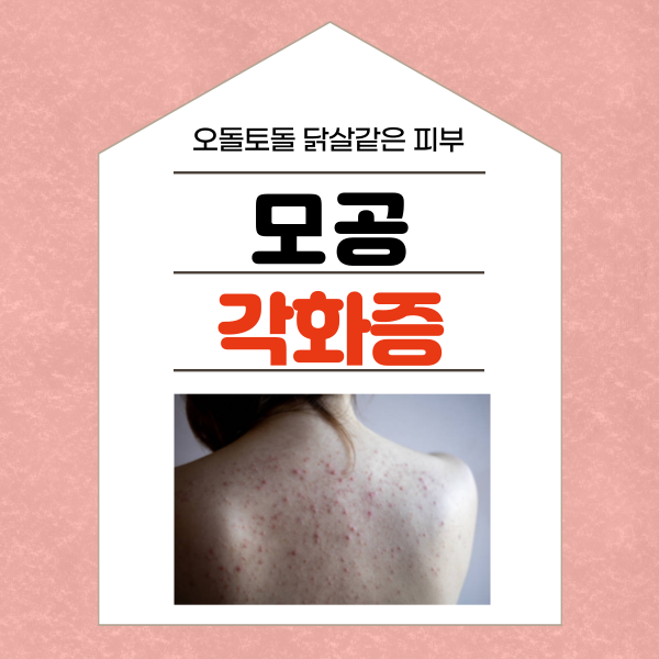  오돌토돌 모공각화증, 닭살과 다른점 증상 원인 치료법 알아보기