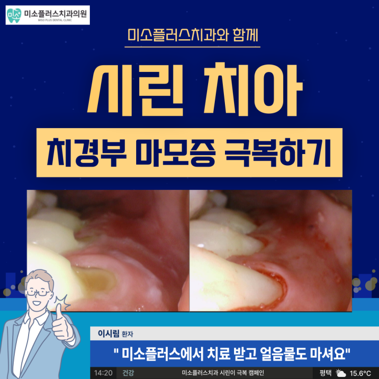  서정리역 치과 평택고덕치과/치경부 마모증 수복