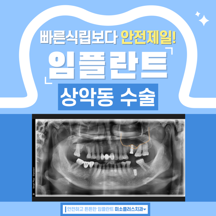  평택고덕치과/상악동 수술