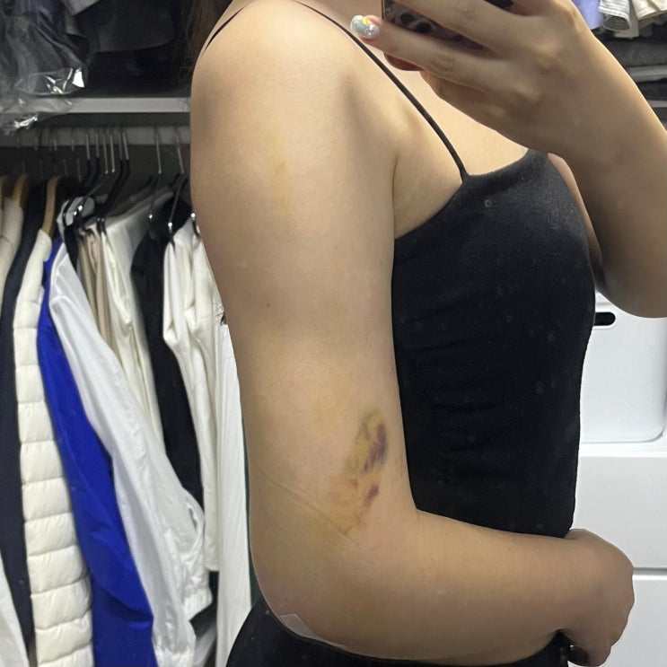  지방추출주사 지팻주사 일주일 후기 (멍 주의) 내돈내산