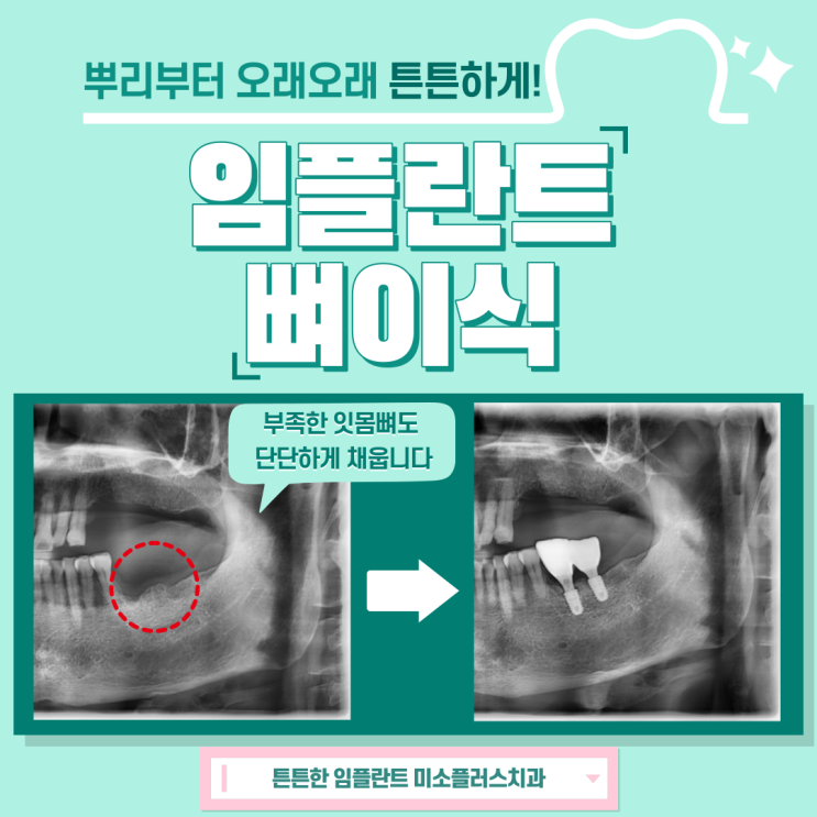  평택고덕치과/임플란트 뼈이식