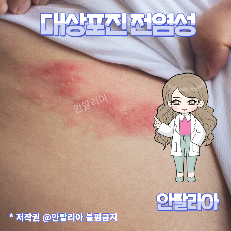 대상포진 초기증상 후신경통,얼굴,/눈 대상포진 증상 : 네이버 블로그