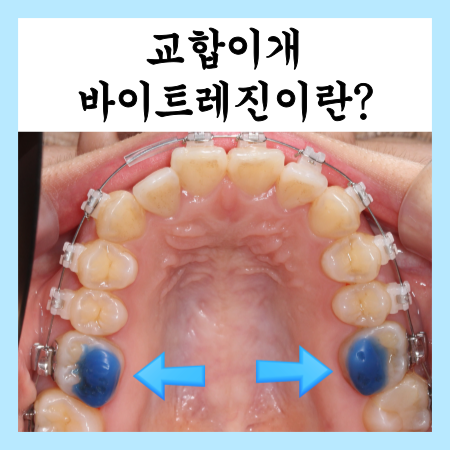  교정시 교합을 띄워주는 바이트레진에 대해서