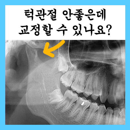  턱이 안좋은데 교정 할 수 있나요? 소리가 날때