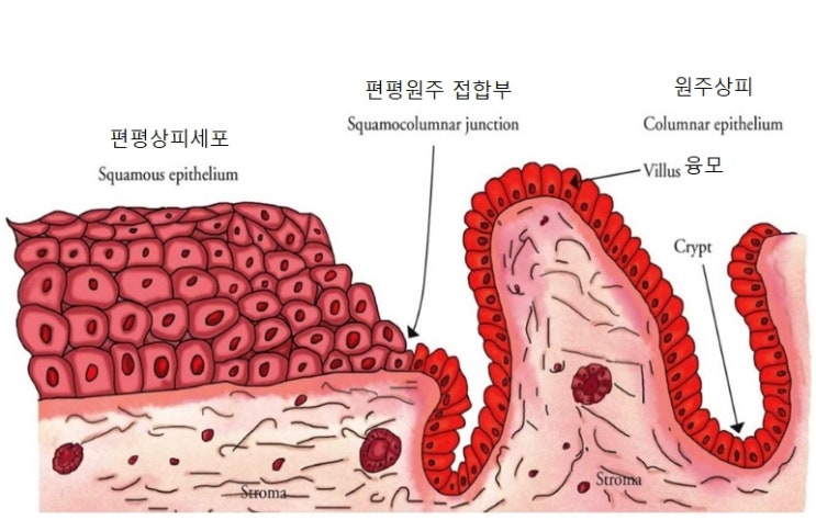  강남산부인과여의사 자궁경부이형성증 발생 과정