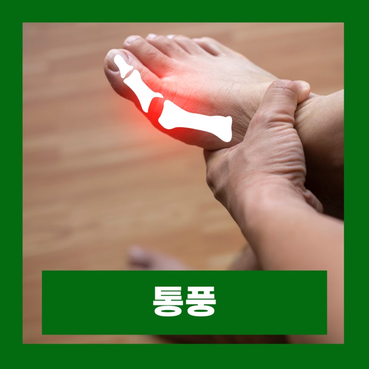  국화페놀 요산수치 낮추는법 통풍 초기증상 알아보기