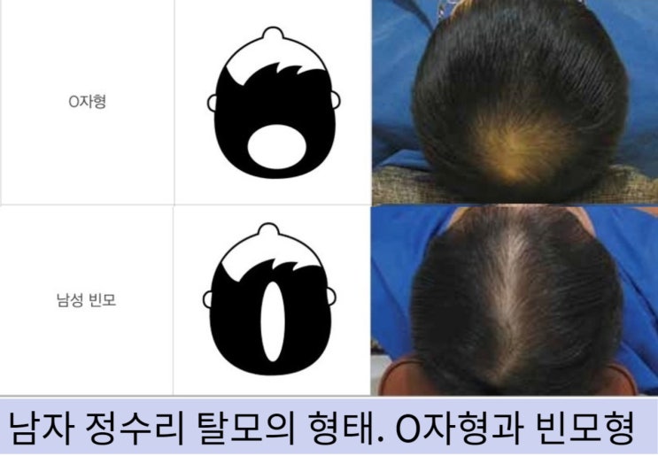  홍대 탈모치료 - 40대 남자 정수리, 늦었다고 생각하는 때가 빠른 때입니다.