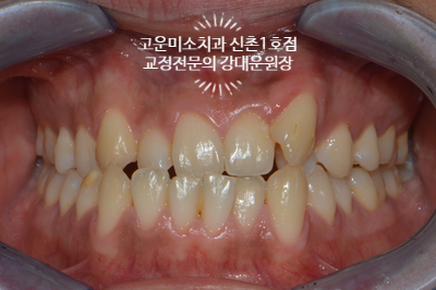  주걱턱 반대교합 치열불규칙을 해결하고싶어 내원하신 3급 부정교합치료증례 신촌교정치과 고운미소 신촌1호점 치료증례
