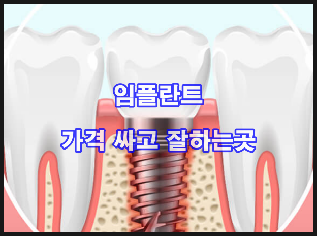  30대 ~ 60대이상 임플란트 잘하는곳 가격 싼곳