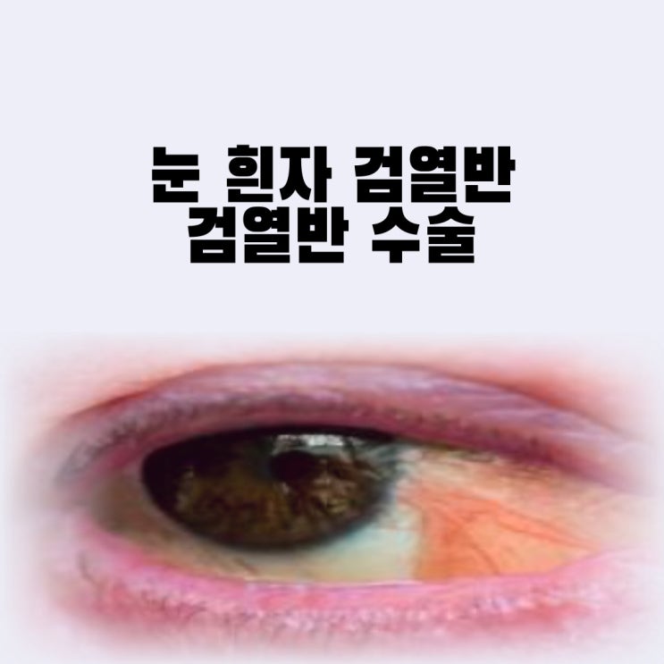 검열반 수술 눈 흰자 검열반 증상 충혈 예방법