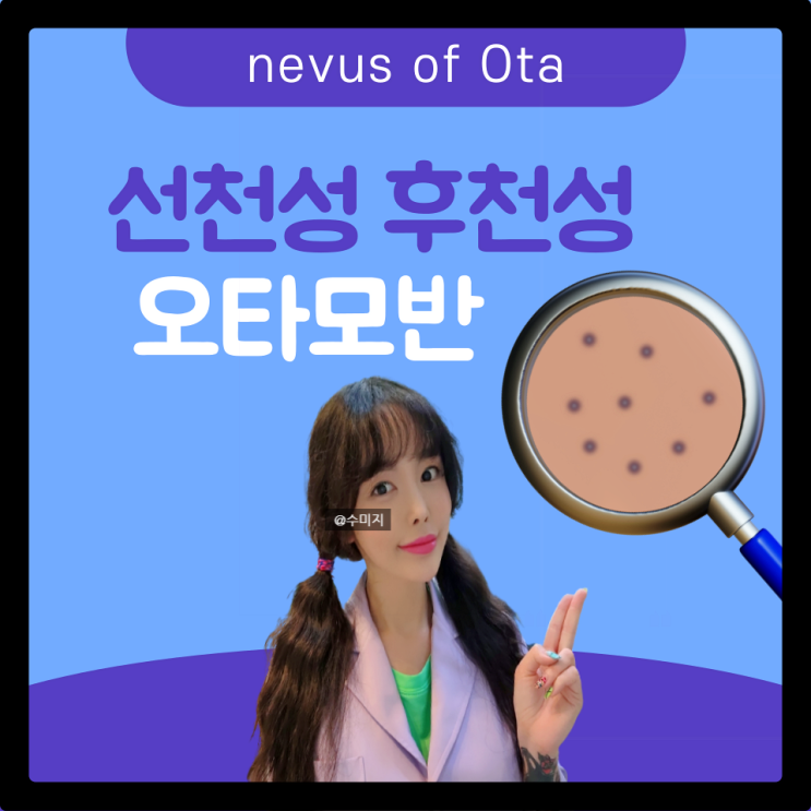  오타모반 : 진피내모반 선천성 모반 화염상모반 후천성 오타모반 치료