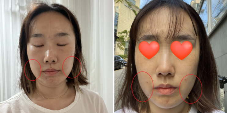  노원 리프테라 주름 리프팅 한달차 효과 리프테라 관리 후기