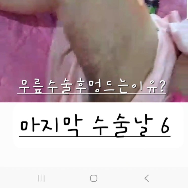  무릎 인공관절 수술 후 멍이 드는 이유, 마지막 수술 날