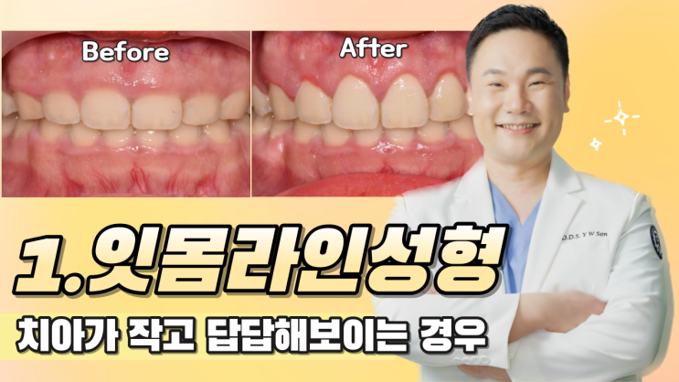  [강남역 치과] 아름다운 미소, 잇몸도 성형이 필요하다