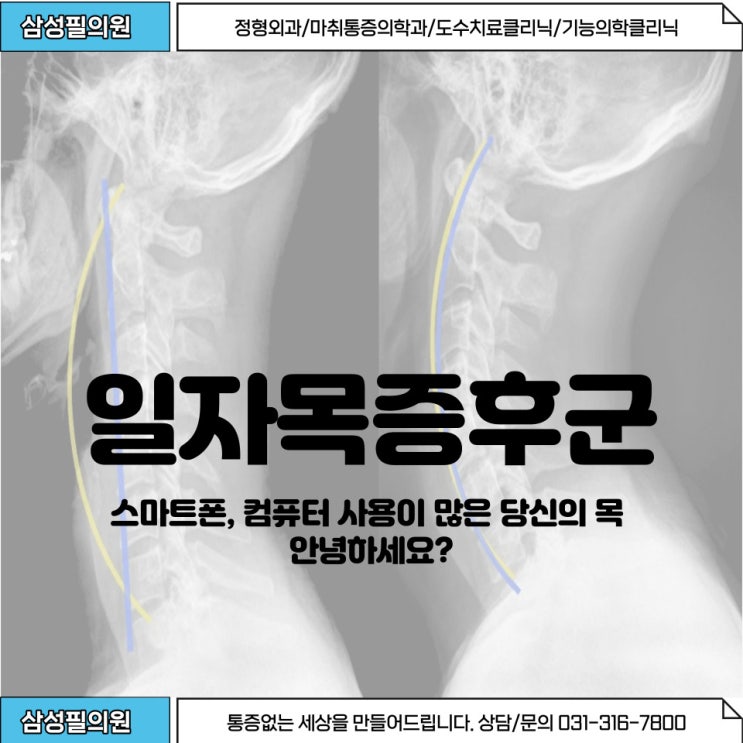  잘못된 자세로 만들어진 거북목증후군,일자목증후군에 대해 알아볼까요?