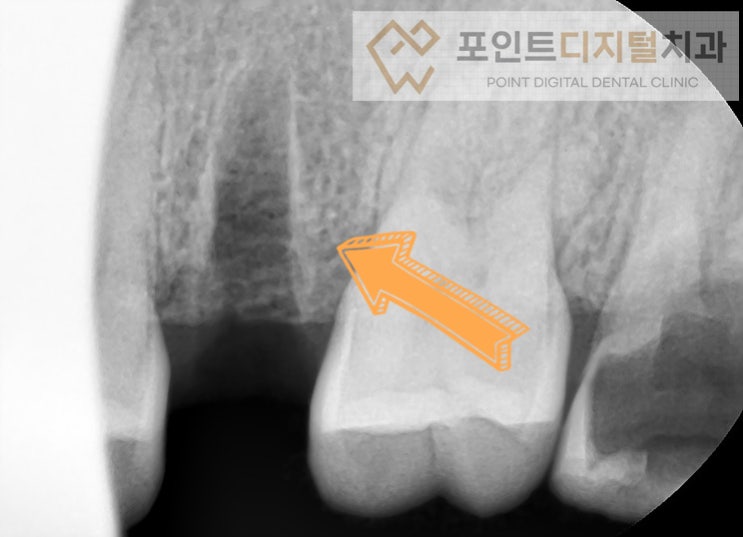  [탕정역임플란트] 충치로 파절된 치아 발치(발치즉시 임플란트, 덴티움)