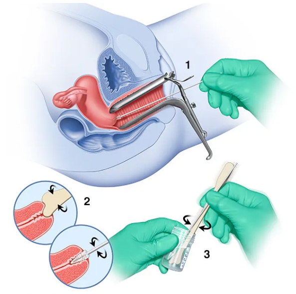  교대역 산부인과 HPV 검사 비용과 방법