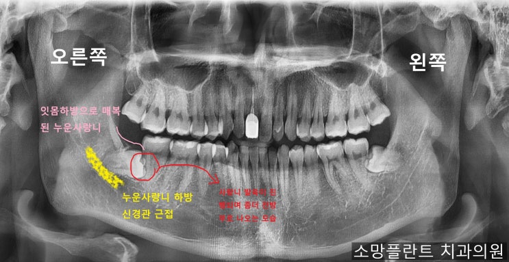  누운 사랑니 발치 언제 뽑는 게 괜찮을까? 사랑니 발치 시기 사랑니 발치 비용 성남 산성역 소망플란트 치과
