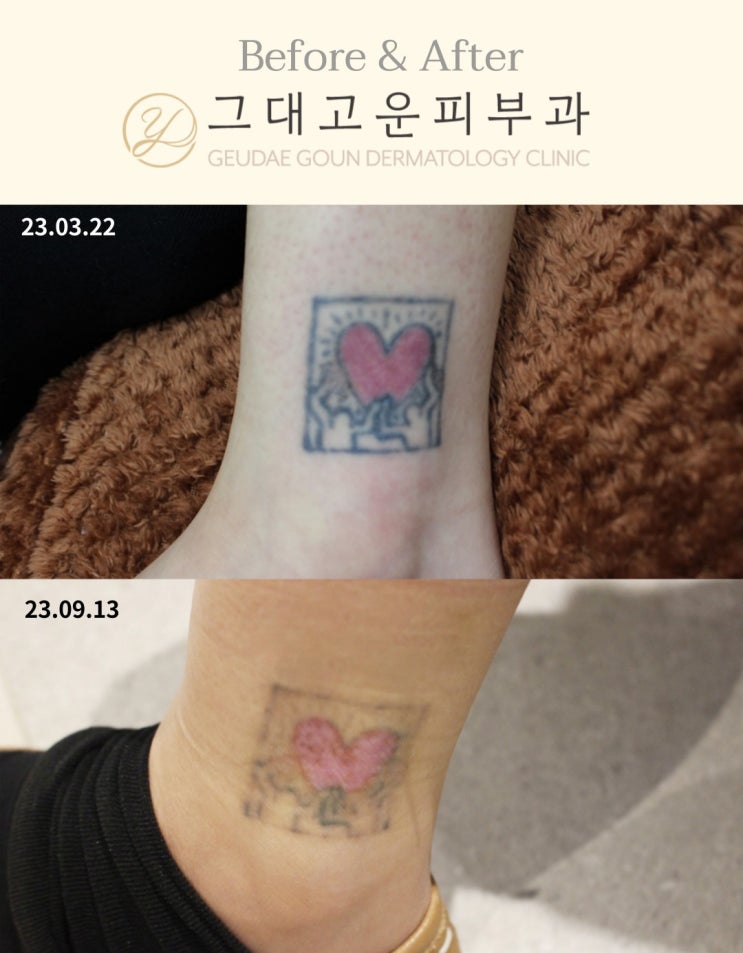부산 문신제거, 몇 번 해야 지워질까? 부산 문신제거, 몇 번 해야 지워질까?