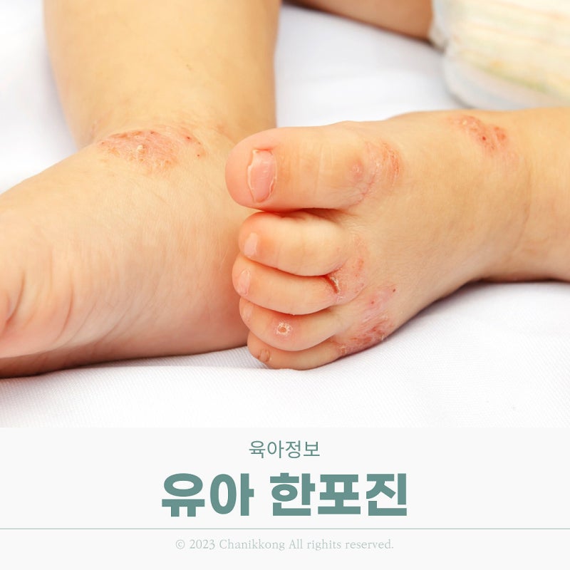 아기 유아 발바닥 한포진 원인과 증상 전염