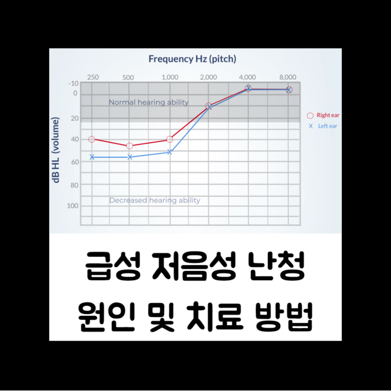 급성저음성난청 원인과 특징 및 치료방법