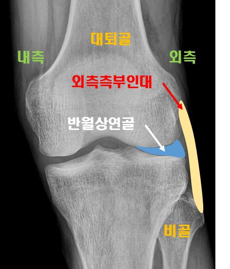  측부인대파열? 무릎 통증 원인이라면