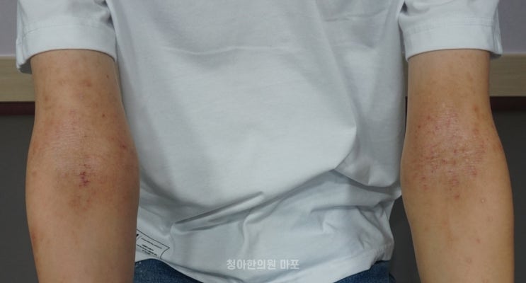  아토피 환자는 과자, 라면 평생 못 먹는 건가요?