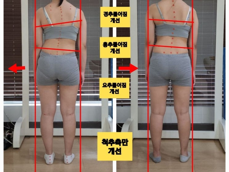  스마트폰 없음 안되는 시대,체형교정은 꼭 필요한 시대(부산사직동 척추측만)
